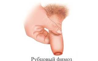 Рубцовый фимоз: основные причины, симптомы  и способы лечения