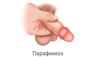 Что такое парафимоз?
