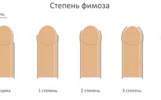 Причины и лечение фимоза у взрослых и детей