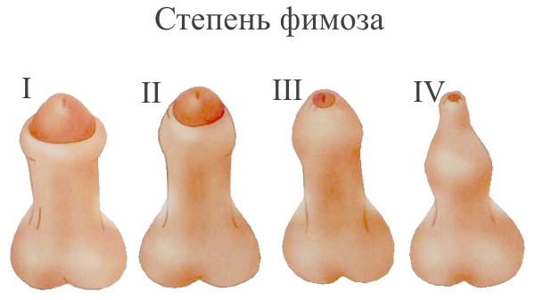 Степень фимоза