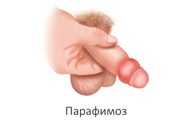 Парафимоз