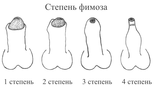 Степень фимоза