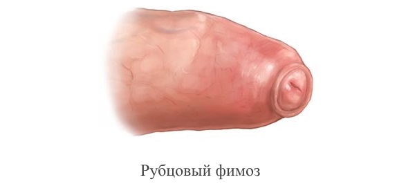 Рубцовый фимоз