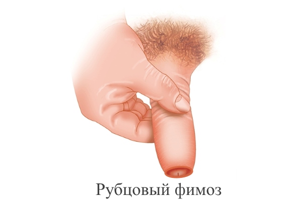 Рубцовый фимоз