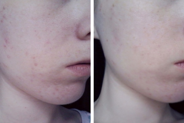 Результат до и после лечения