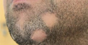 Почему проявляется алопеция на бороде? Способы лечения и профилактики